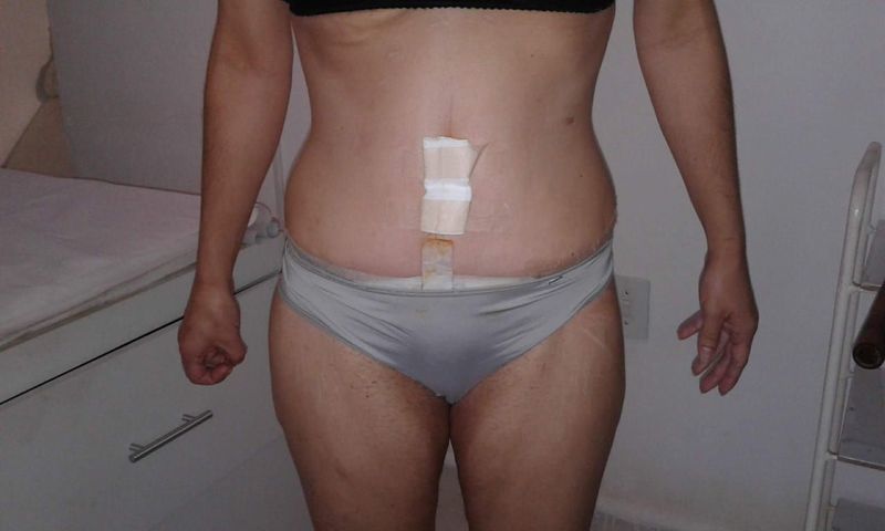 Drenagem linfática pós operatório.
Cliente fez abdominoplastia. massoterapeuta esteticista aromaterapeuta