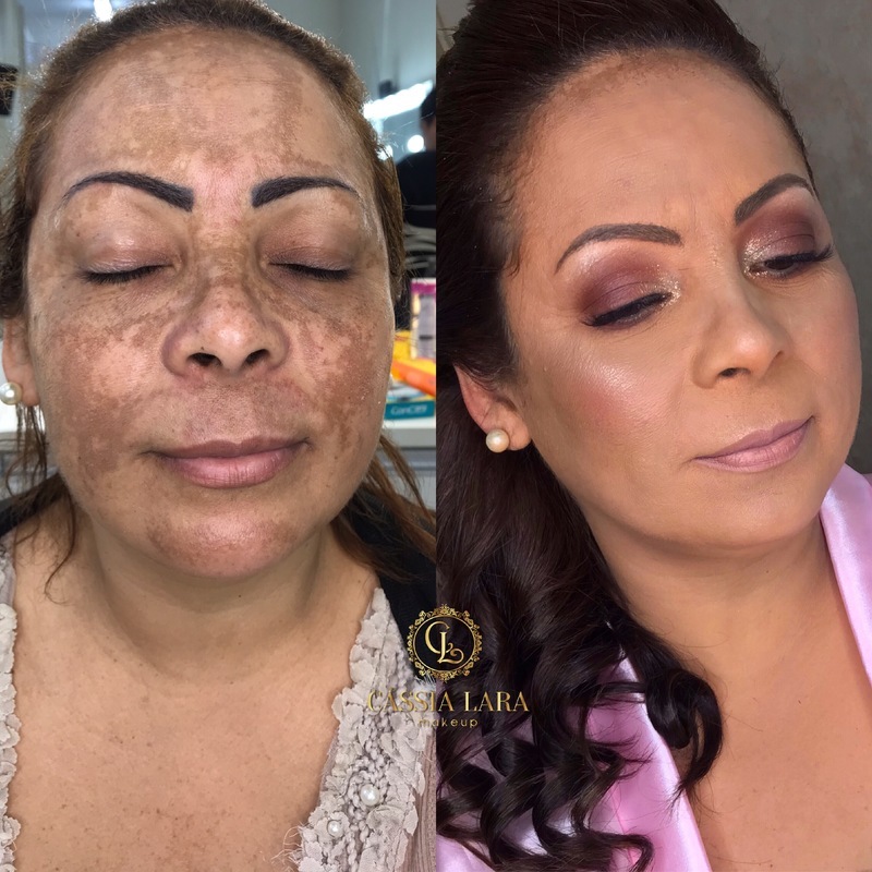 Cobertura de melasma!
#maquiadorasaovicente #maquiadorasantos #antesedepoismake #melasma  maquiagem maquiador(a)
