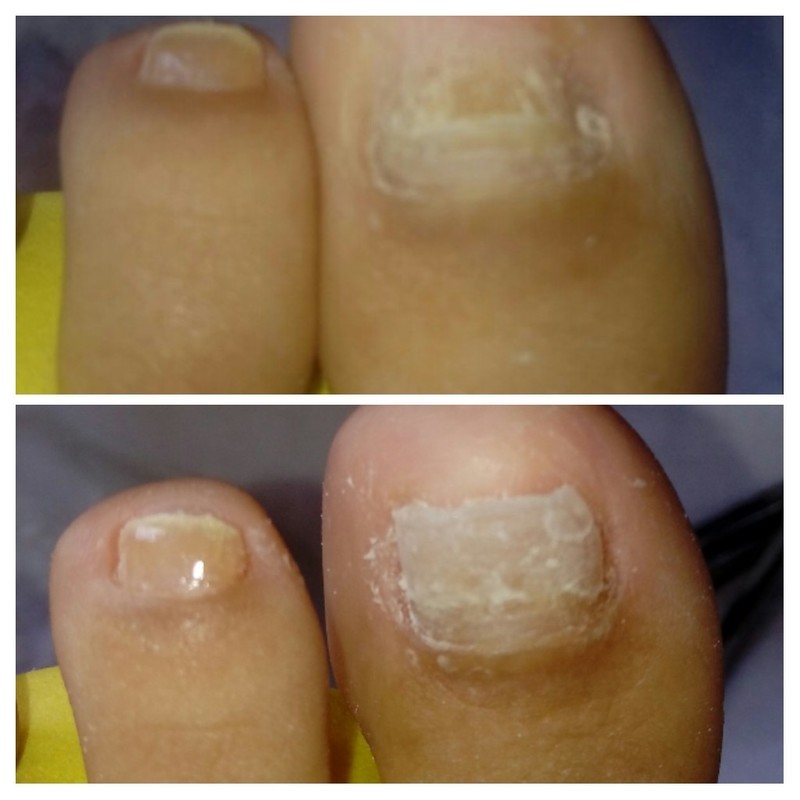 Correção da Lâmina com acrílico.
24 de março de 2019. unha podólogo(a) manicure e pedicure