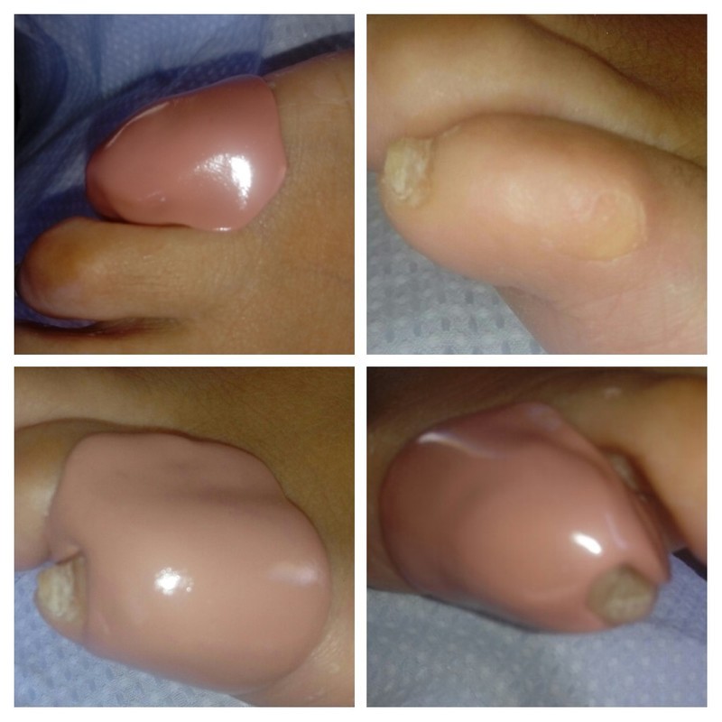 Órtese de silicone, para aliviar as dores e incomodos causados por calos.
24 de março de 2019. outros podólogo(a) manicure e pedicure