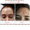 Tratamento de acne