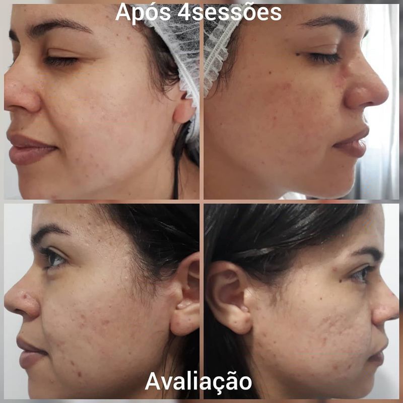 Tratamento cicatriz de acne estética esteticista massoterapeuta