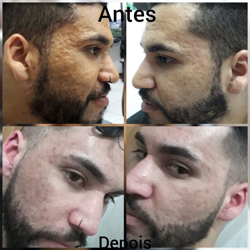Cicatriz de acne estética esteticista massoterapeuta