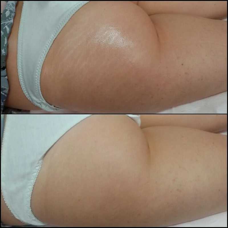 Dermopuntura - tratamento para estrias estética dermopigmentador(a) designer de sobrancelhas biomédico(a) maquiador(a) outros