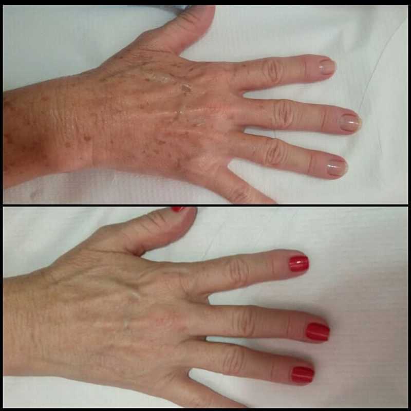 Jato de plasma para manchas senis - resultado antes e cicatrizado após 15 dias - apenas 1 sessão! estética dermopigmentador(a) designer de sobrancelhas biomédico(a) maquiador(a) outros