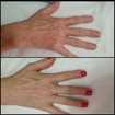 Jato de plasma para manchas senis - resultado antes e cicatrizado após 15 dias - apenas 1 sessão!