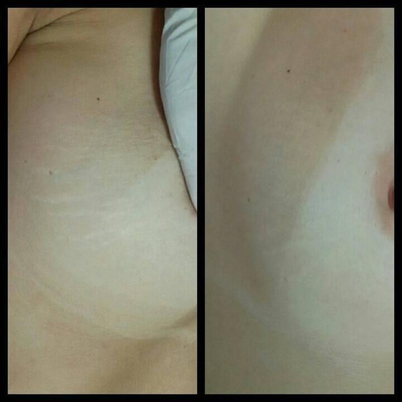 Tratamento para estrias - dermopuntura - antes e resultado parcial de 1 sessão estética dermopigmentador(a) designer de sobrancelhas biomédico(a) maquiador(a) outros