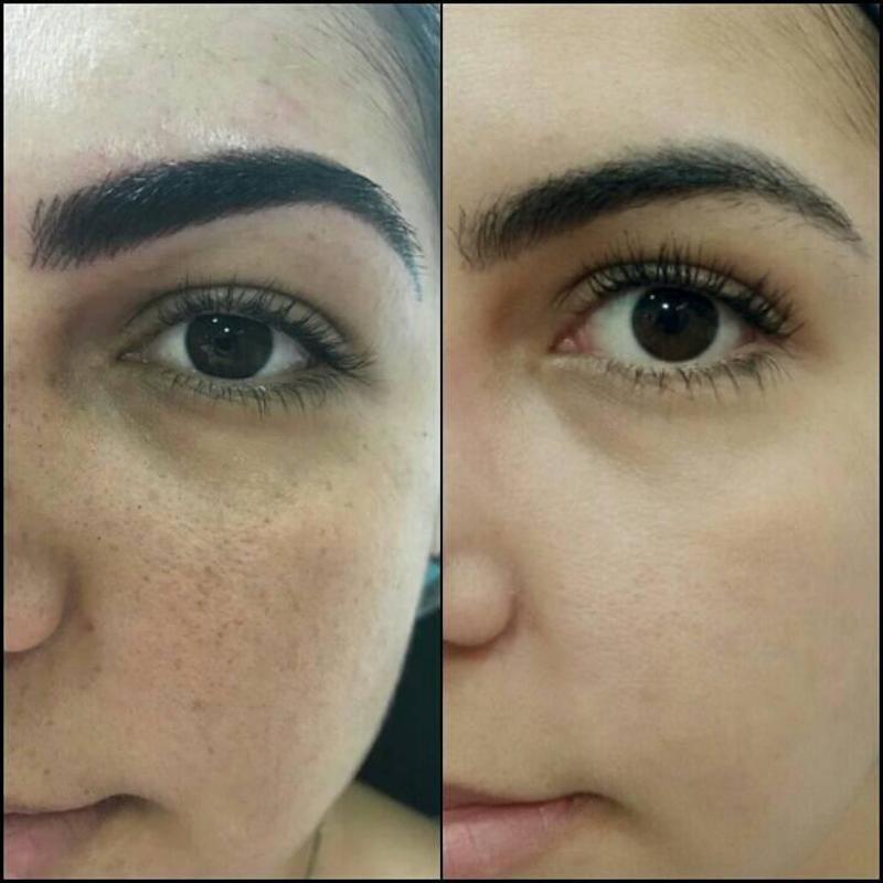 Jato de plasma - resultado de apenas uma sessão para manchas de sol estética dermopigmentador(a) designer de sobrancelhas biomédico(a) maquiador(a) outros