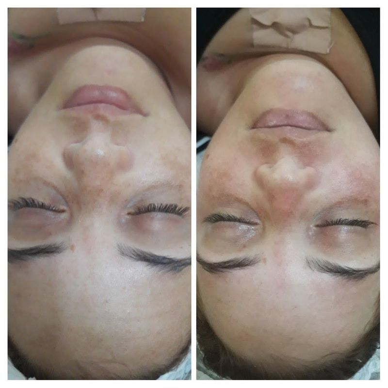 Primeira sessão de pela nova,estou amando estética esteticista