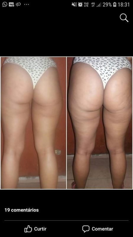 Massagem detox,em apenas uma sessão, resultado maravilhoso e gratificante 😍 estética esteticista