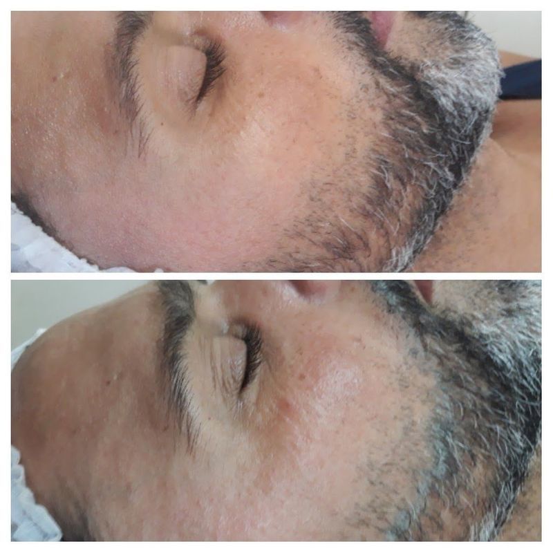 Uma única sessão de pele nova e feeling de diamante,sucesso😉 estética esteticista