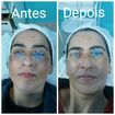 Peeling para melasma