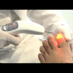 Tratamento laserterapia