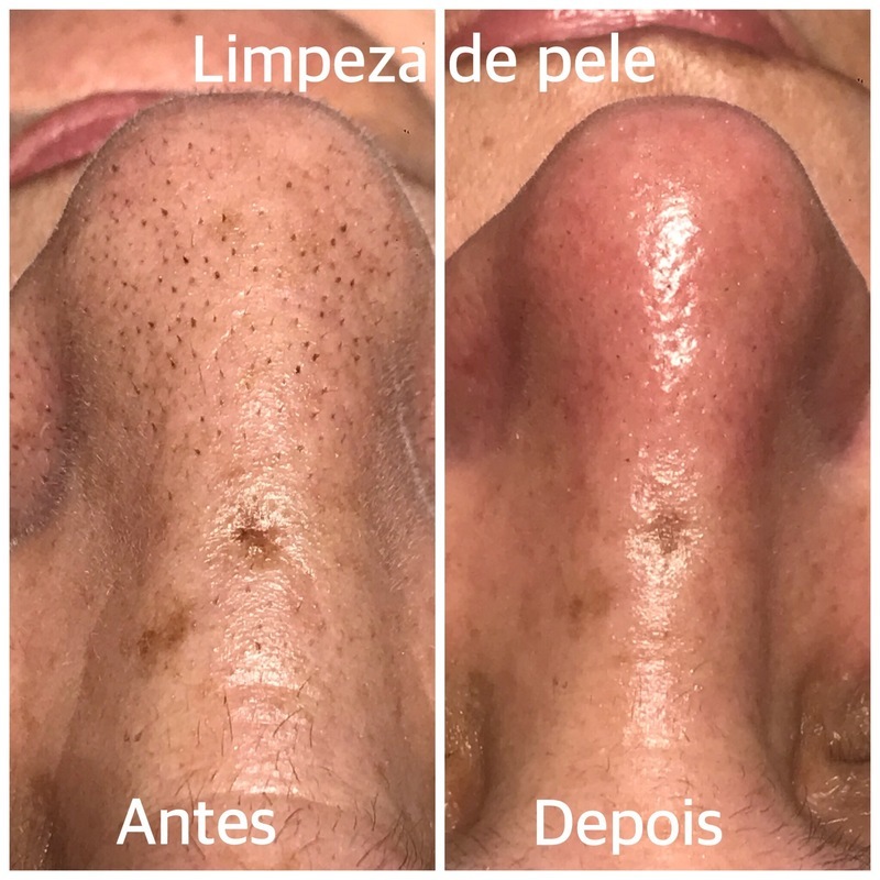 Sempre há a necessidade de se fazer uma boa limpeza de pele.
#beleza
#pele
#estetica
#saude 
#saudeebemesta
#trabalhocomamor  estética esteticista manicure e pedicure designer de sobrancelhas depilador(a)