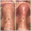 Sempre há a necessidade de se fazer uma boa limpeza de pele.
#beleza
#pele
#estetica
#saude 
#saudeebemesta
#trabalhocomamor 