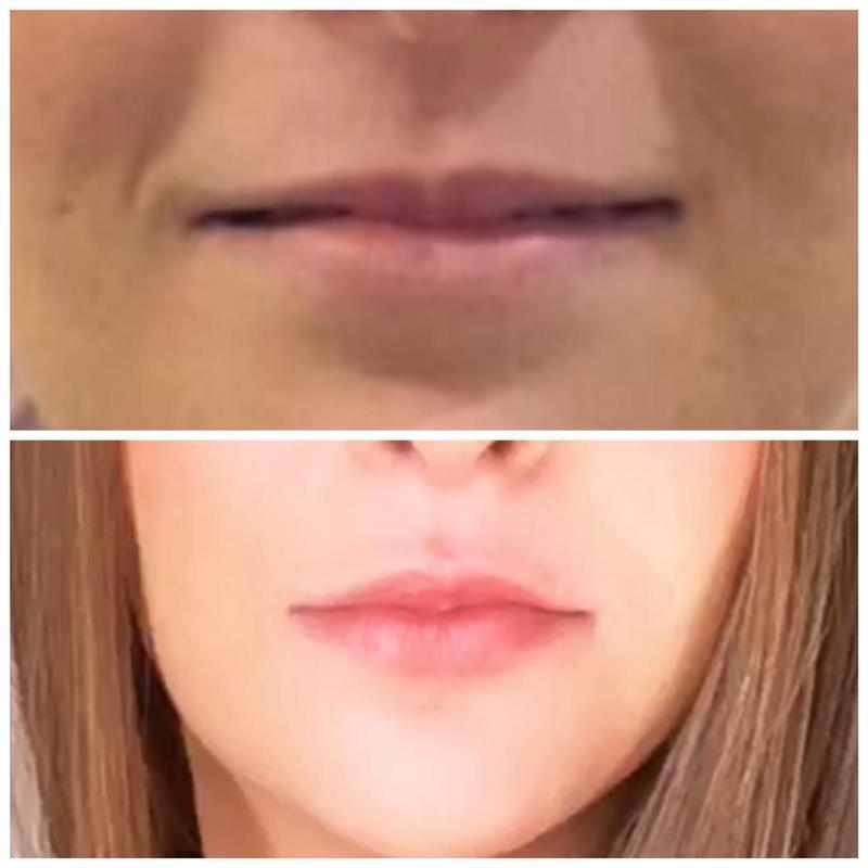 Preenchimento labial  outros biomédico(a)