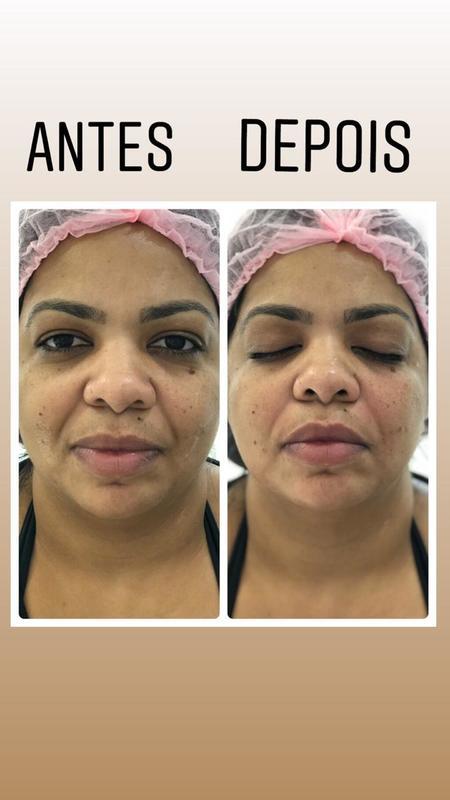 Prenchimento Sulco nasogeniano com apenas 1mL estética biomédico(a)