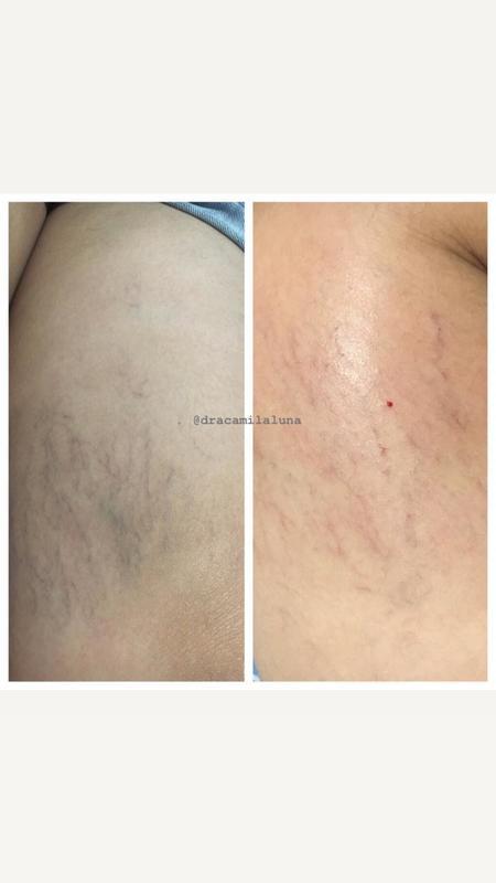 Apenas 3 sessões de Escleroterapia outros biomédico(a)