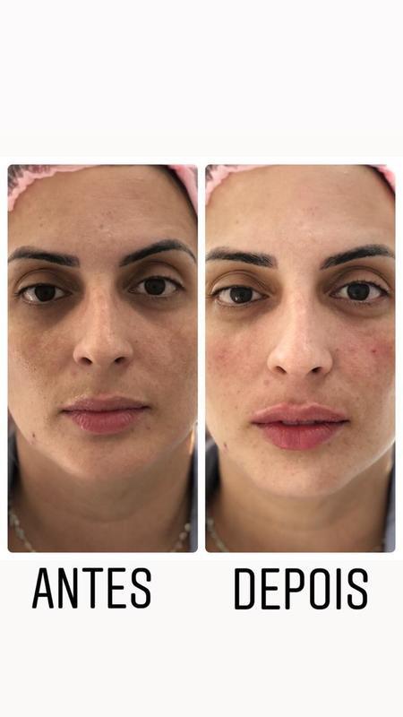 Preenchimento olheira e contorno da boca estética biomédico(a)