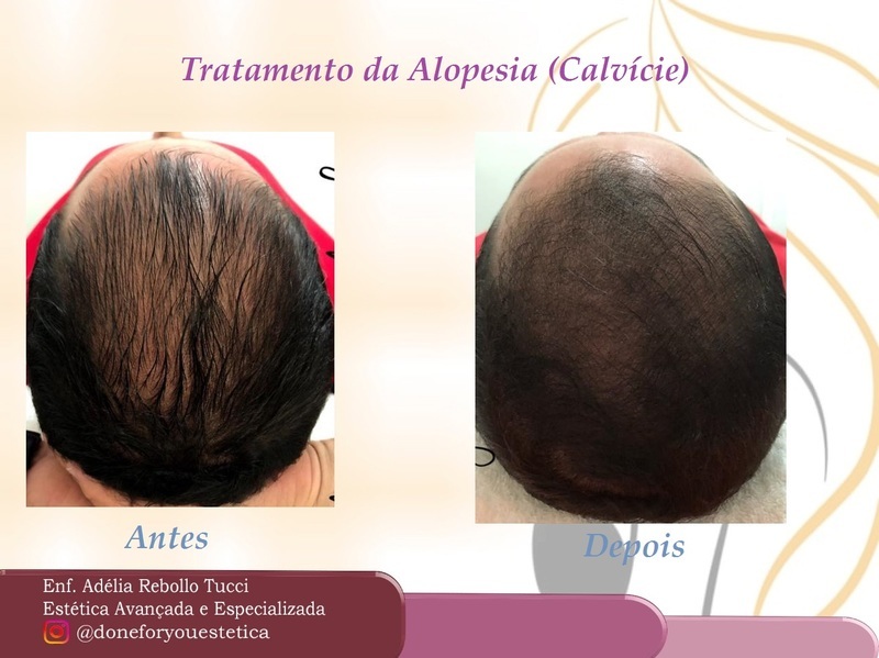 Tratamento de mesoterapia capilar, 2 sessões cabelo enfermeiro(a)