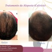 Tratamento de mesoterapia capilar, 2 sessões