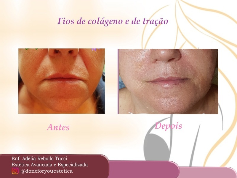 Fios de tração em região de bigode chinês. Utilizado 4 fios em cada lado do rosto estética enfermeiro(a)