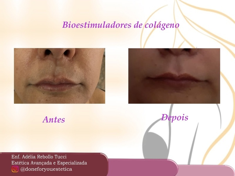 Estimulador de Colágeno na face, resultado após 45 dias. estética enfermeiro(a)