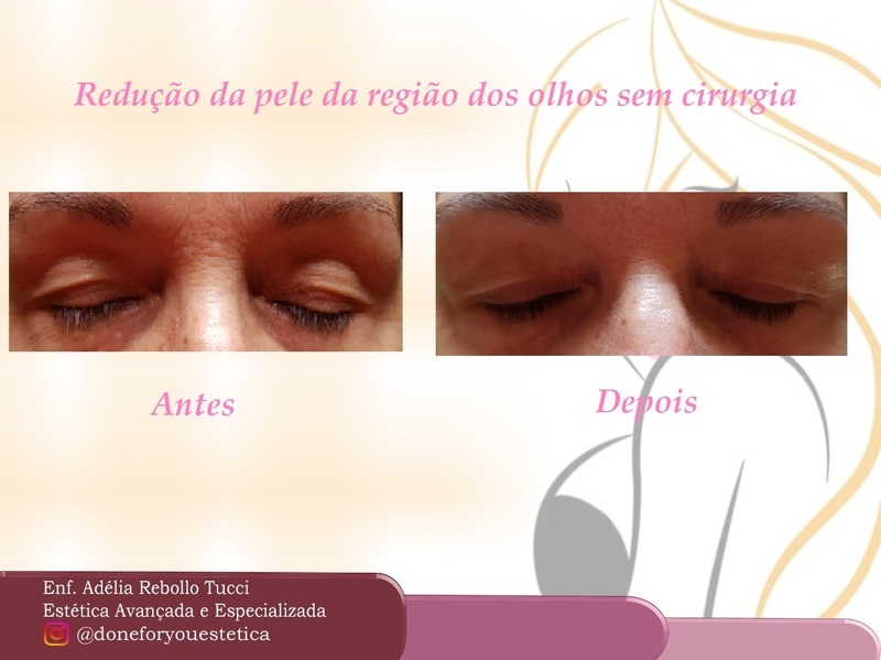 Redução da pele na região dos olhos com jato de plasma, 2 sessões. estética enfermeiro(a)