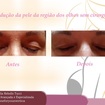 Redução da pele na região dos olhos com jato de plasma, 2 sessões.