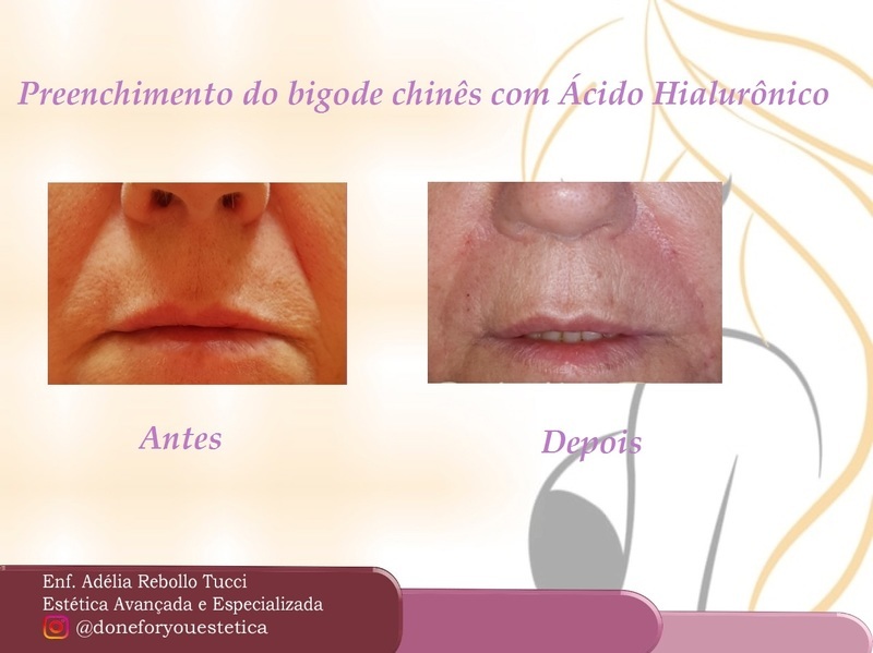 Preenchimento de bigode chinês com ácido hialurônico.  estética enfermeiro(a)