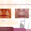 Preenchimento de bigode chinês com ácido hialurônico. 