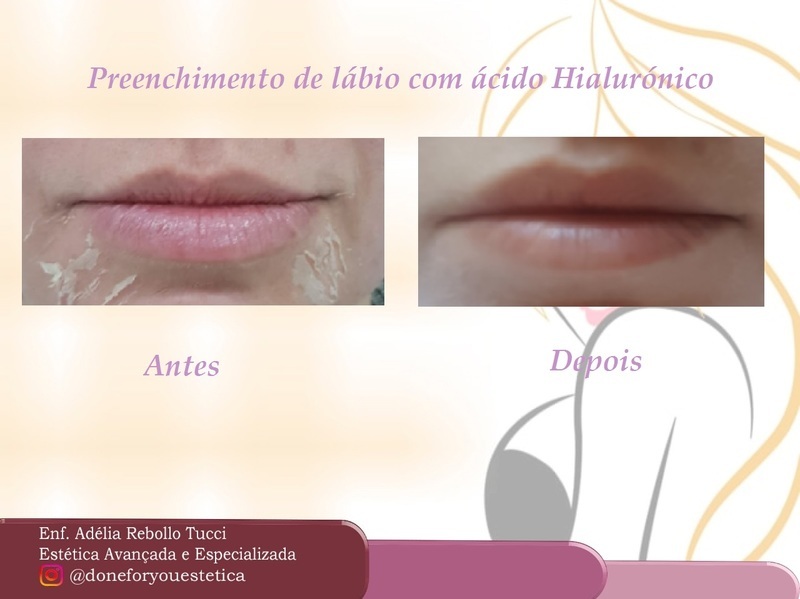 Preenchimento de lábio com ácido hialurônico;  estética enfermeiro(a)