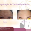 Aplicação de Toxina Botulínica (BOTOX)