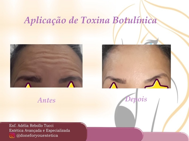 Aplicação de Toxina Botulínica (BOTOX) estética enfermeiro(a)