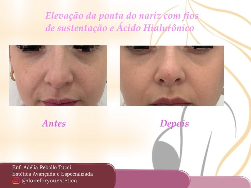 Elevação da ponta do nariz com Fios de tração e Preenchimento.  estética enfermeiro(a)