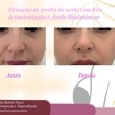 Elevação da ponta do nariz com Fios de tração e Preenchimento. 