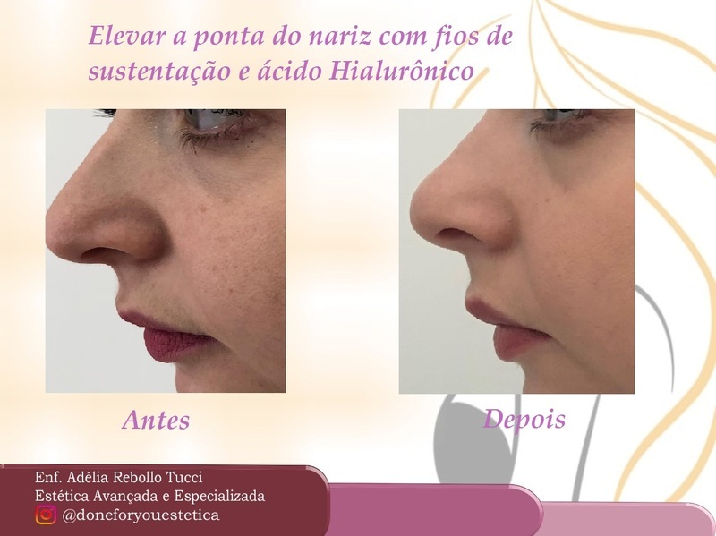 Elevação da ponta do nariz com Fios de tração com Preenchimento. Visão de perfil. estética enfermeiro(a)
