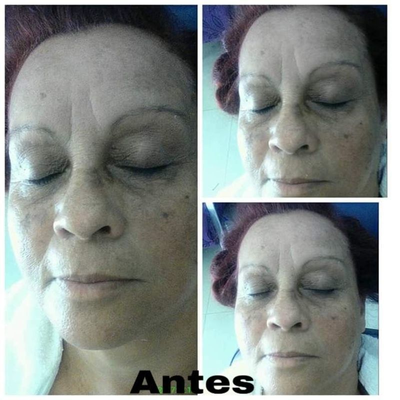 ANTES :Pele madura com melisma , olheiras profundas e sobrancelhas finas. cabeleireiro(a) maquiador(a)