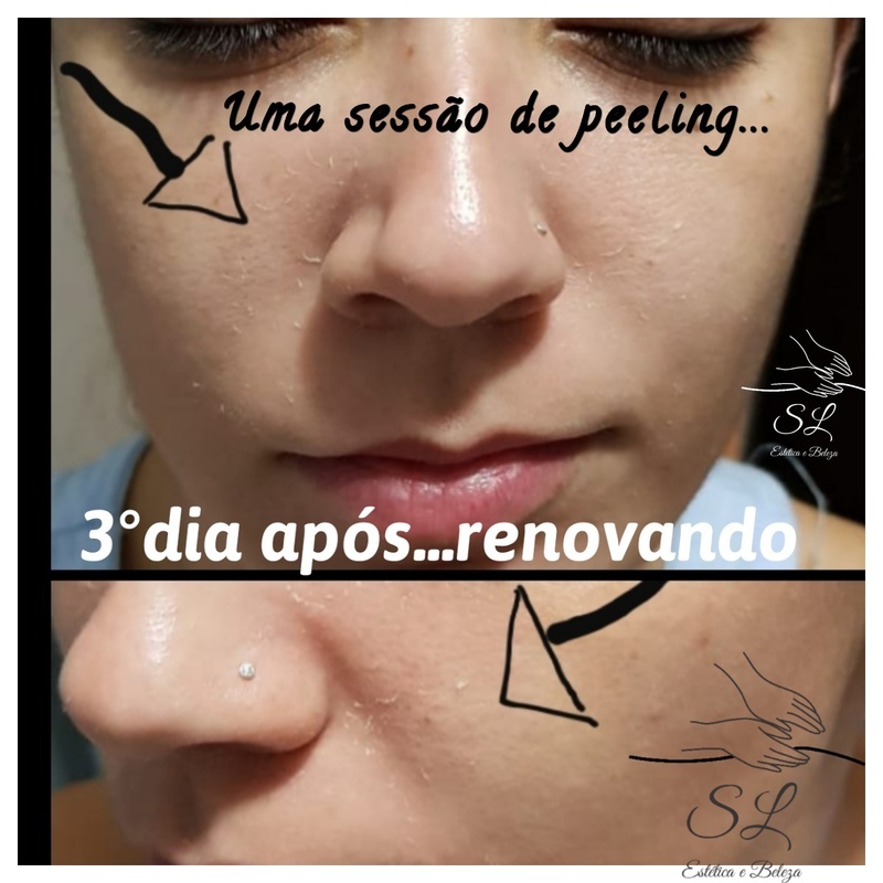 Tratamento de peeling estética esteticista