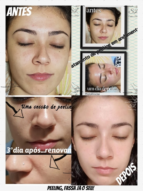 clareamento com peeling estética esteticista