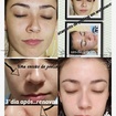 clareamento com peeling