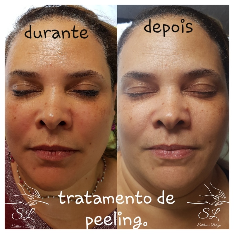 uniformização com peeling  quimico estética esteticista
