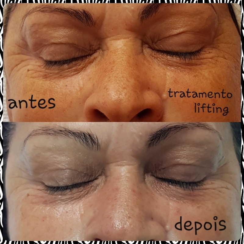 lifting com microcorrente. estética esteticista