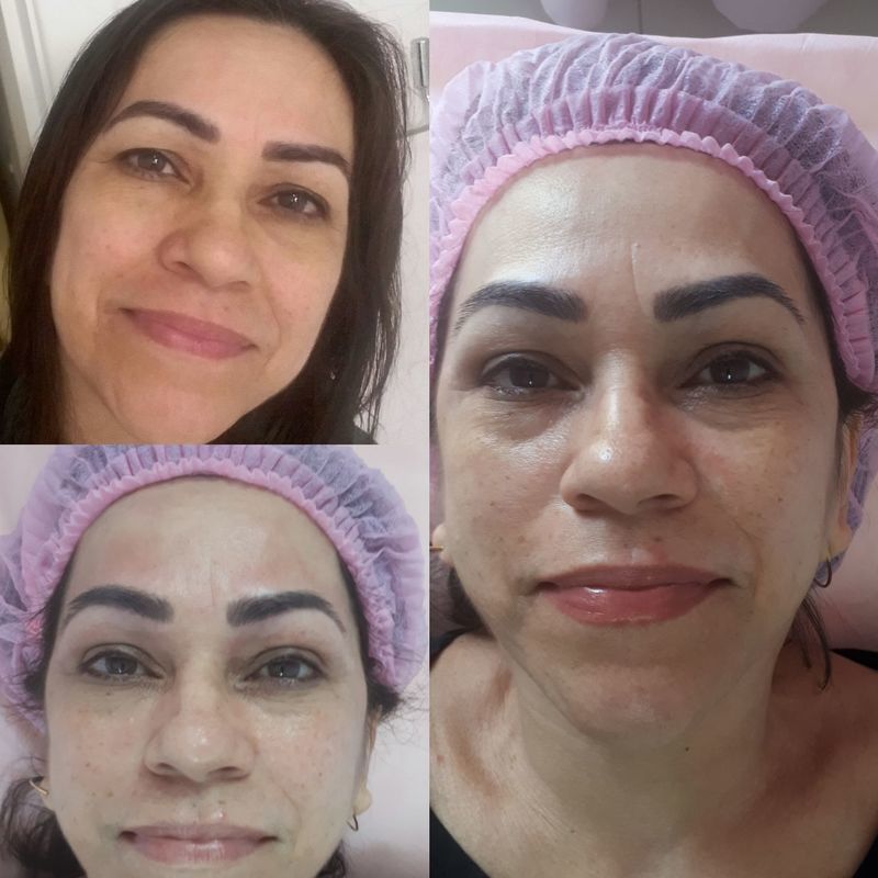 BB GLOW  tratamento facial inovador na estética facial. Trata manchas na pele, linhas de expressões, rugas, rosácea,  manchas de acne, rejuvenescimento da pele. Temos 5 protocolos para cada tipo de tratamento.  São necessárias 3 seções para total eficácia do tratamento.  Essa foto 1 seção do tratamento. micropigmentador(a) designer de sobrancelhas esteticista