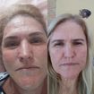 BB GLOW primeira seção do tratamento para manchas de acne.
