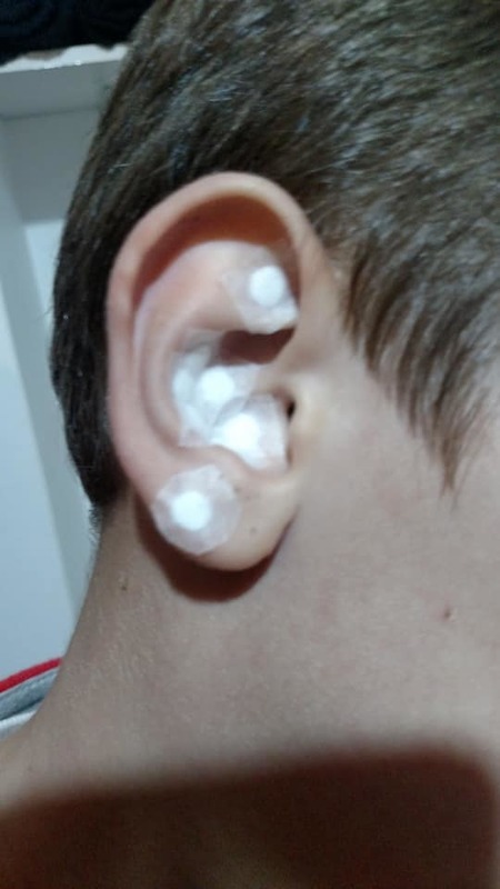 Auriculoterapia com stiper tratando criança com autismo outros massoterapeuta aromaterapeuta quiropraxista acupunturista outros