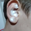 Auriculoterapia com stiper tratando criança com autismo