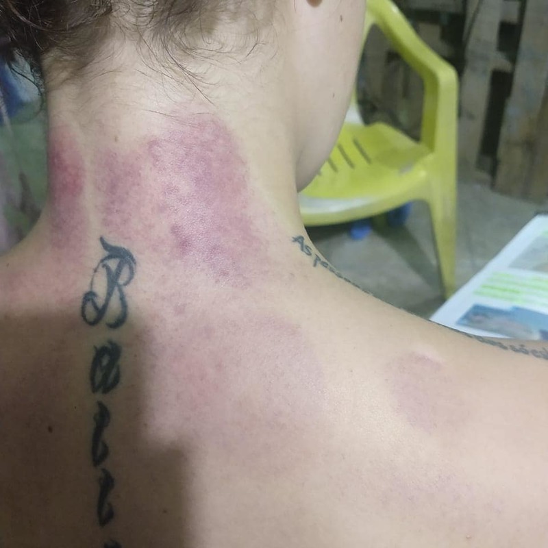 Ventosaterapia torcicolo outros massoterapeuta aromaterapeuta quiropraxista acupunturista outros