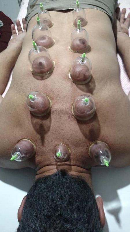 Ventosaterapia  outros massoterapeuta aromaterapeuta quiropraxista acupunturista outros