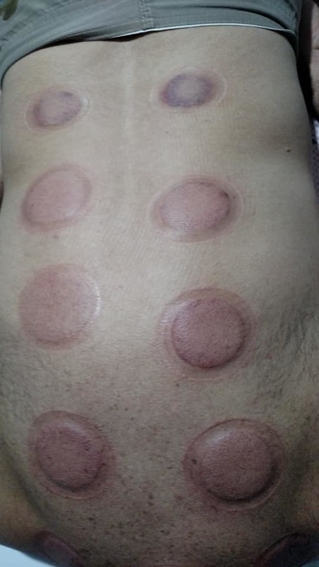 Resultado da ventosaterapia outros massoterapeuta aromaterapeuta quiropraxista acupunturista outros